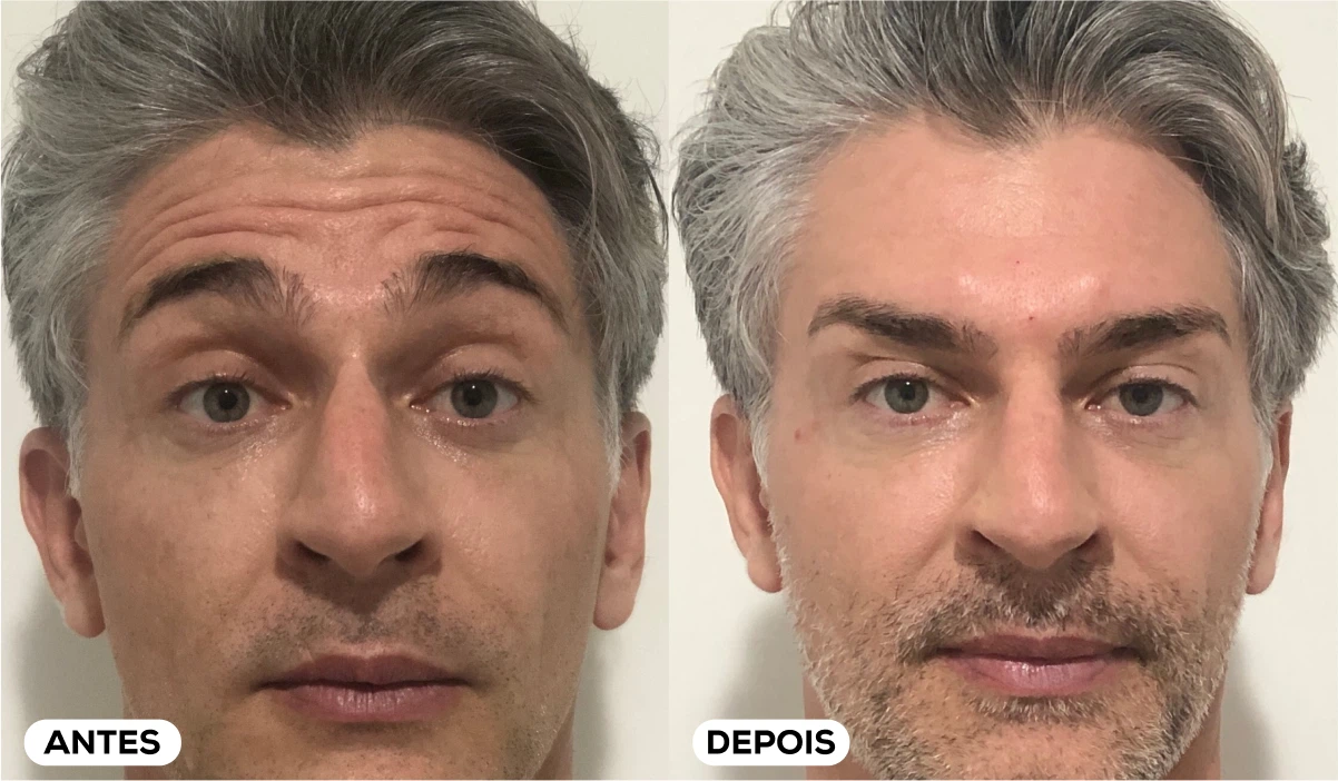 Antes e Depois - Aplicação Toxina Botulínica 6