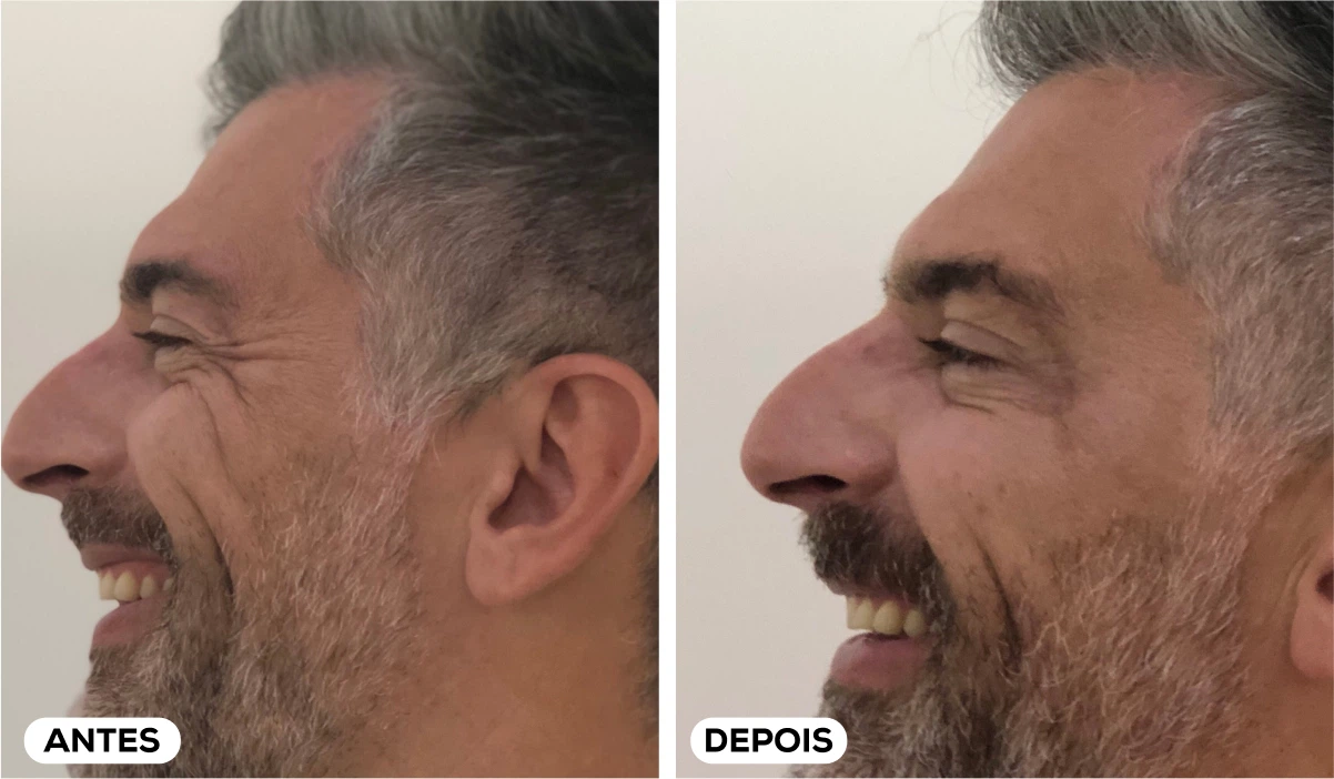 Antes e Depois - Aplicação Toxina Botulínica 8