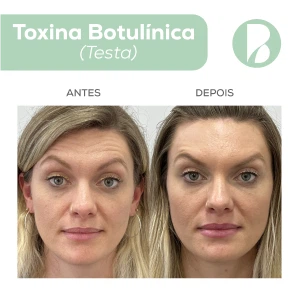 Toxina Botulínica - Exemplo 2