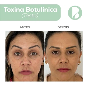 Toxina Botulínica - Exemplo 4