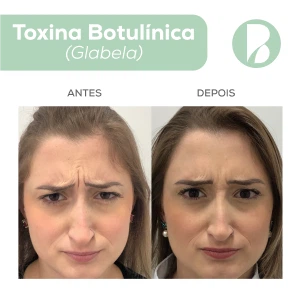 Toxina Botulínica - Exemplo 4